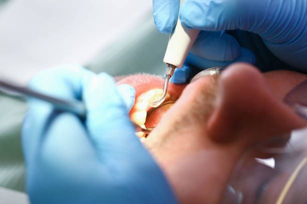 Best Emergency Tooth Extraction in Tiffin, IA